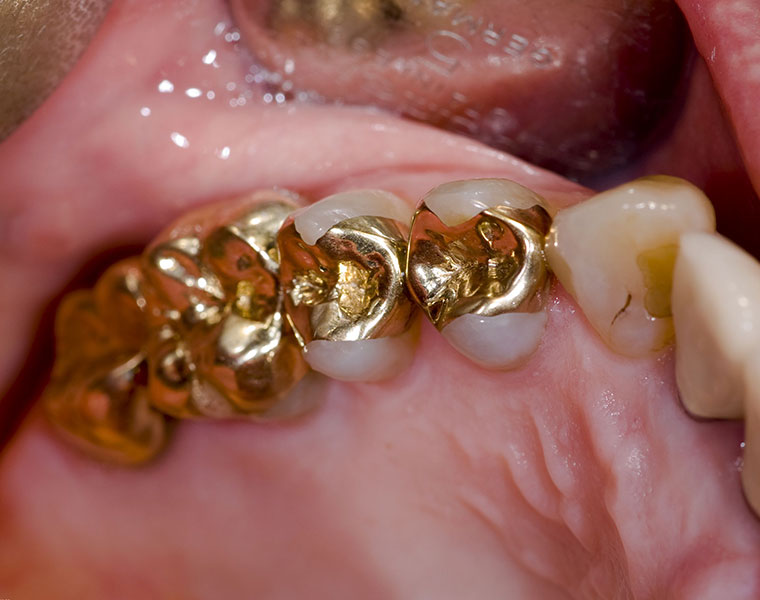 Goldzahnfüllungen in der Zahnarztpraxis Peter La Rue in Aldersbach