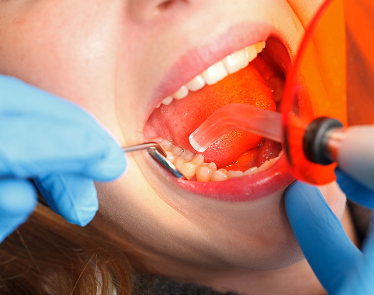 Füllungstherapie in der Zahnarztpraxis Peter La Rue in Aldersbach