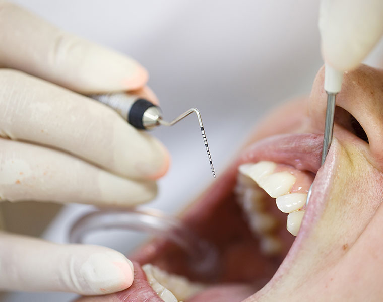 Behandlungsinstrumente für den Bereich Parodontologie in der Zahnarztpraxis Peter La Rue in Aldersbach