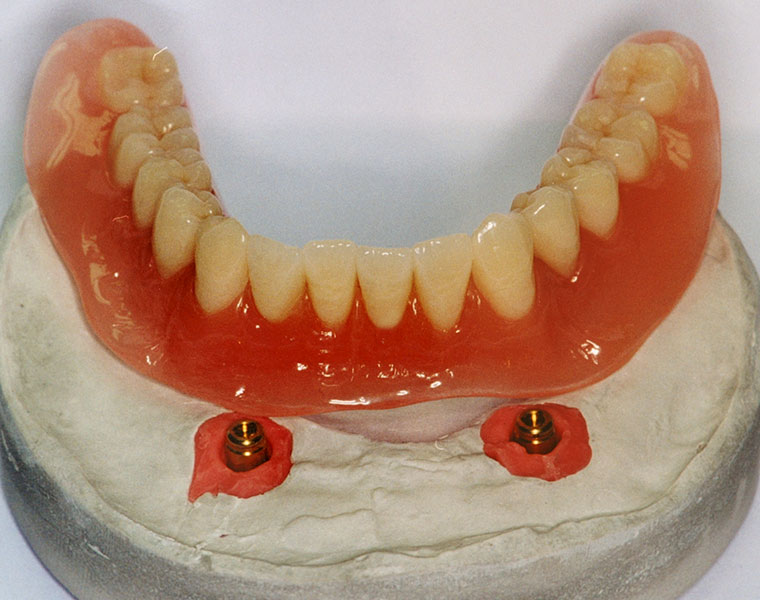 Individueller Zahnersatz bei Ihrem Zahnarzt Peter La Rue in Aldersbach