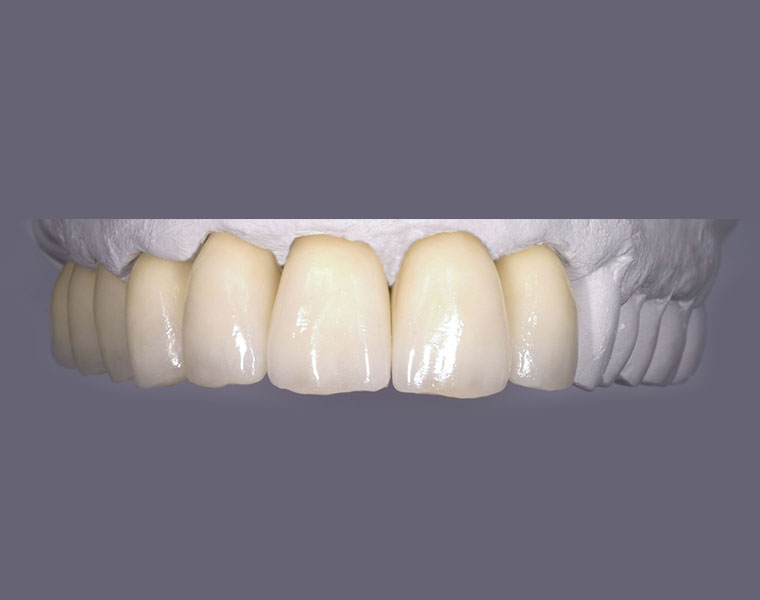 Individuell angepasster Zahnersatz bei Ihrem Zahnarzt Peter La Rue in Aldersbach